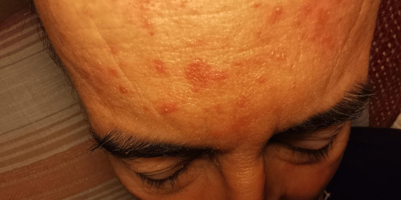 roaccutane acne justkosme