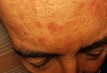 roaccutane acne justkosme