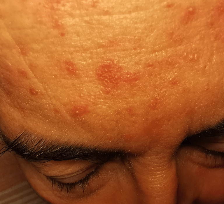 roaccutane acne justkosme